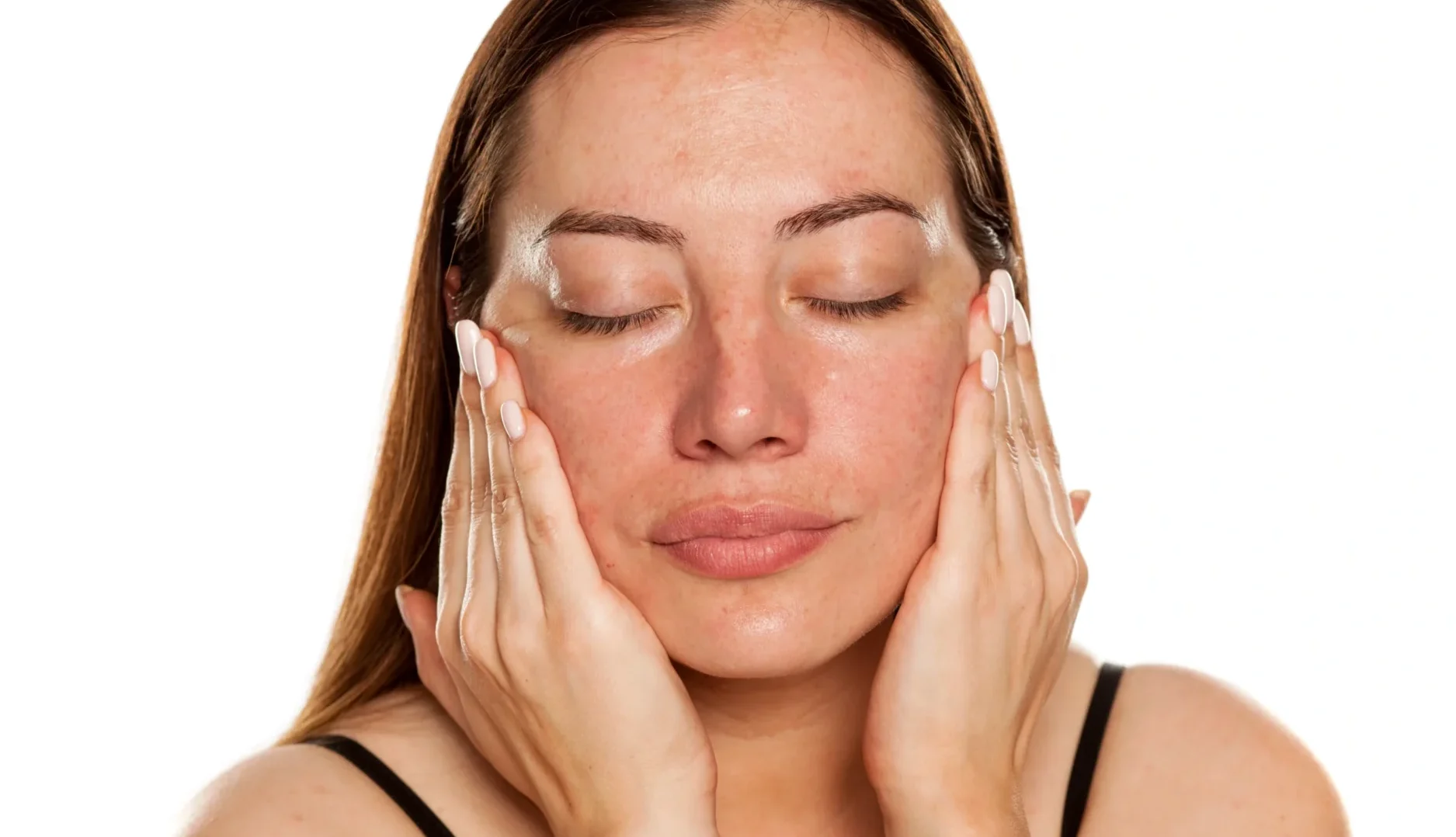Melasma tem tratamento: Descubra os cuidados